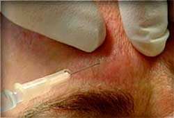 Ботокс  используется  для разглаживания морщин на лице